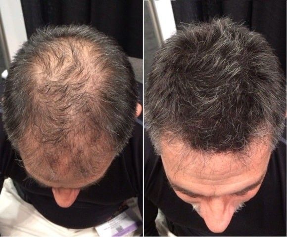 Acne Scar Camouflage — Skin Resurfacing