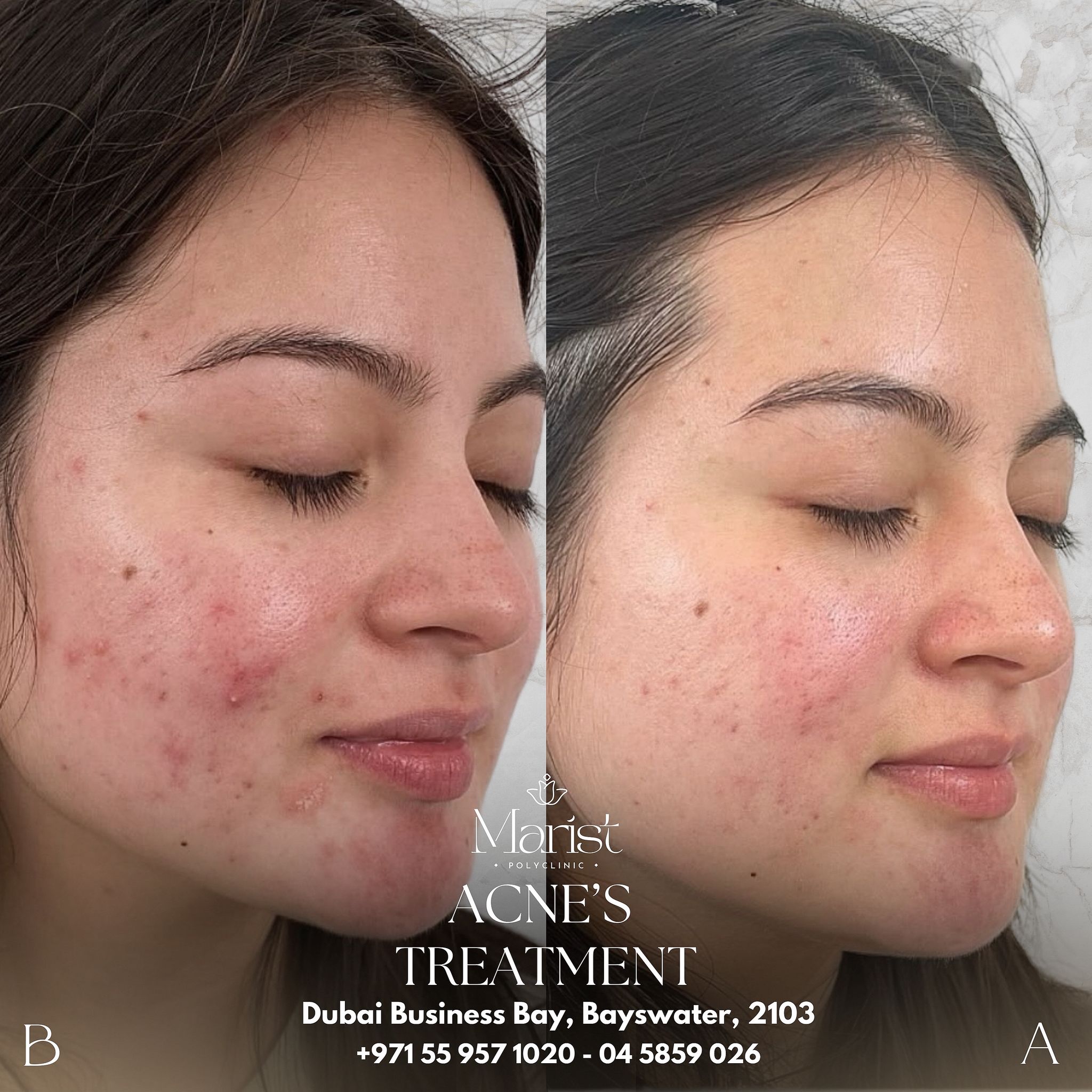 Acne Treatment — Clear Skin Transformation