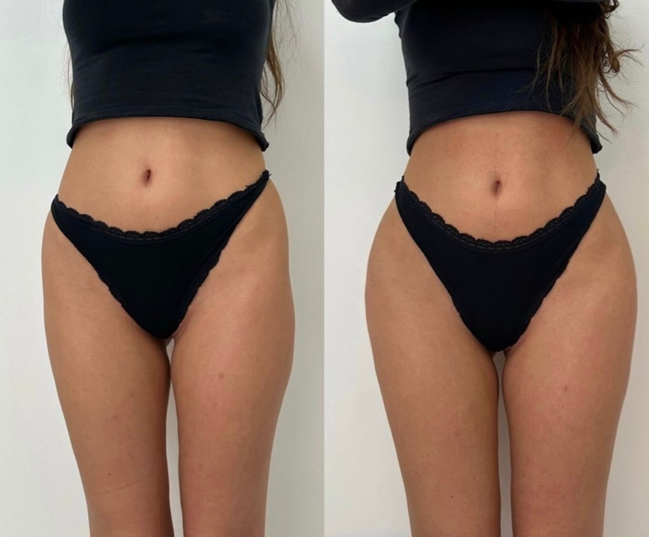Body Contouring — Slimming & Toning