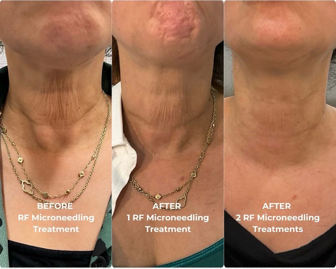 Back Fat Reduction — Body Sculpting
