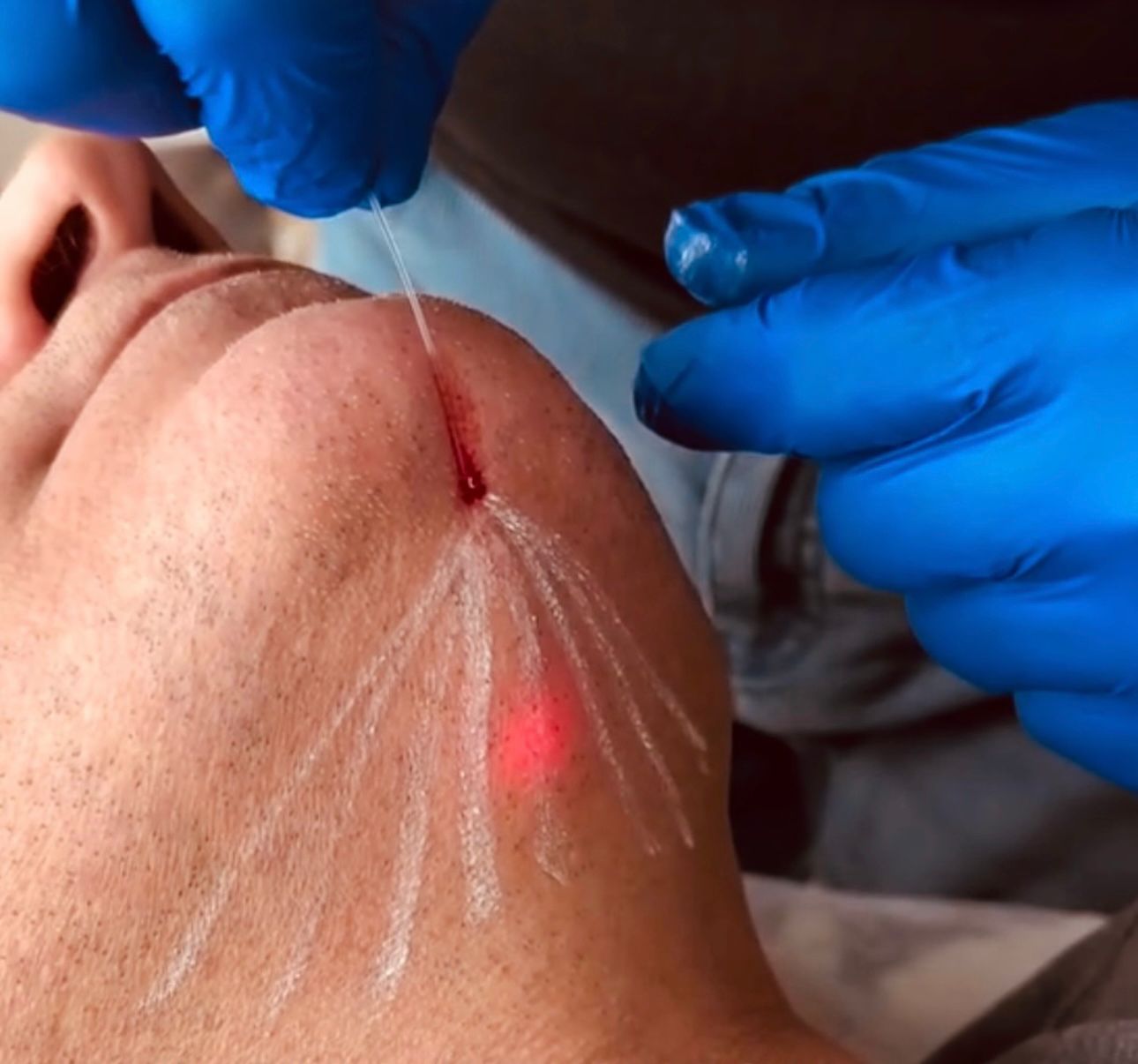Endolift — Laser Skin Tightening