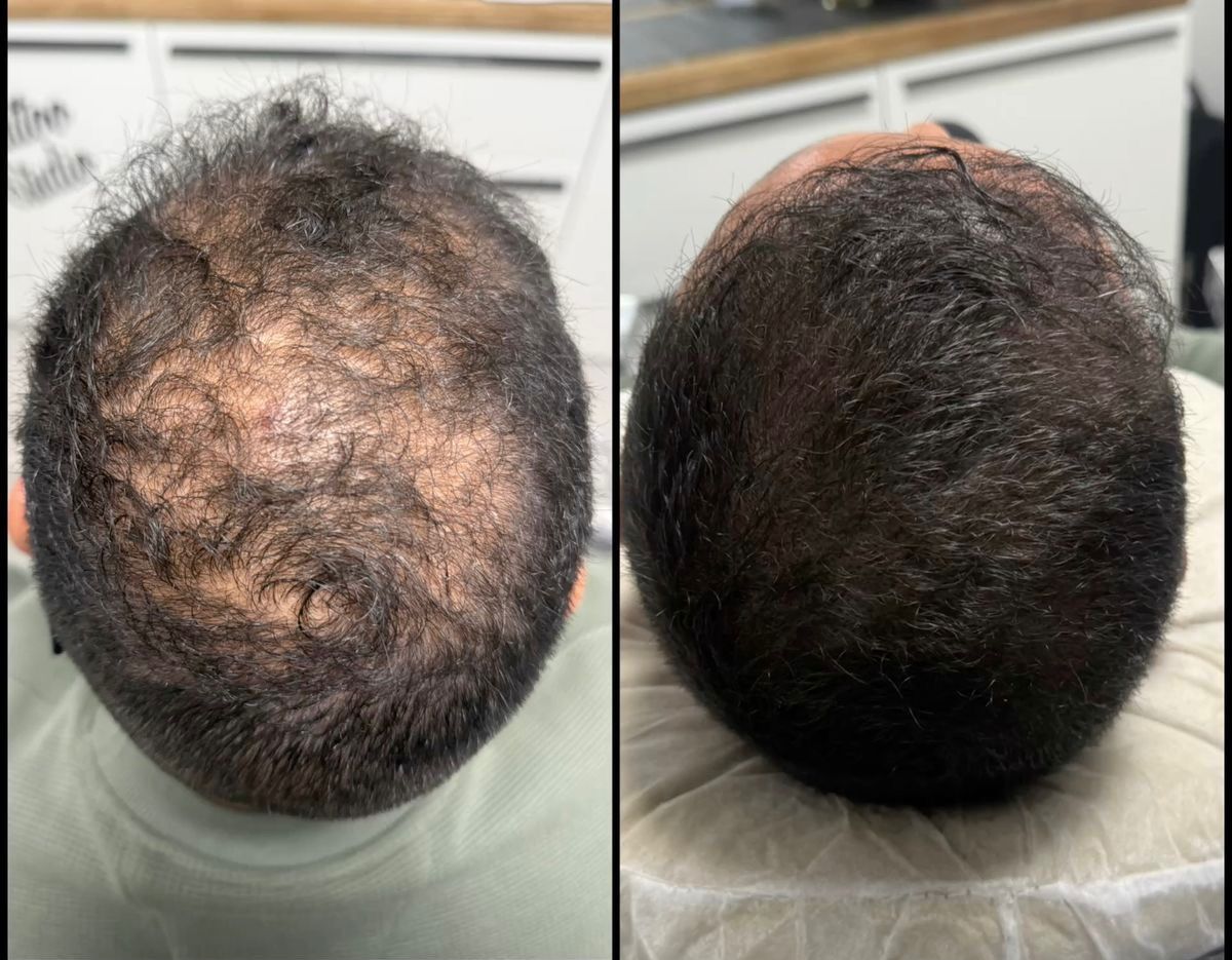 Hair Restoration — Crown Area
