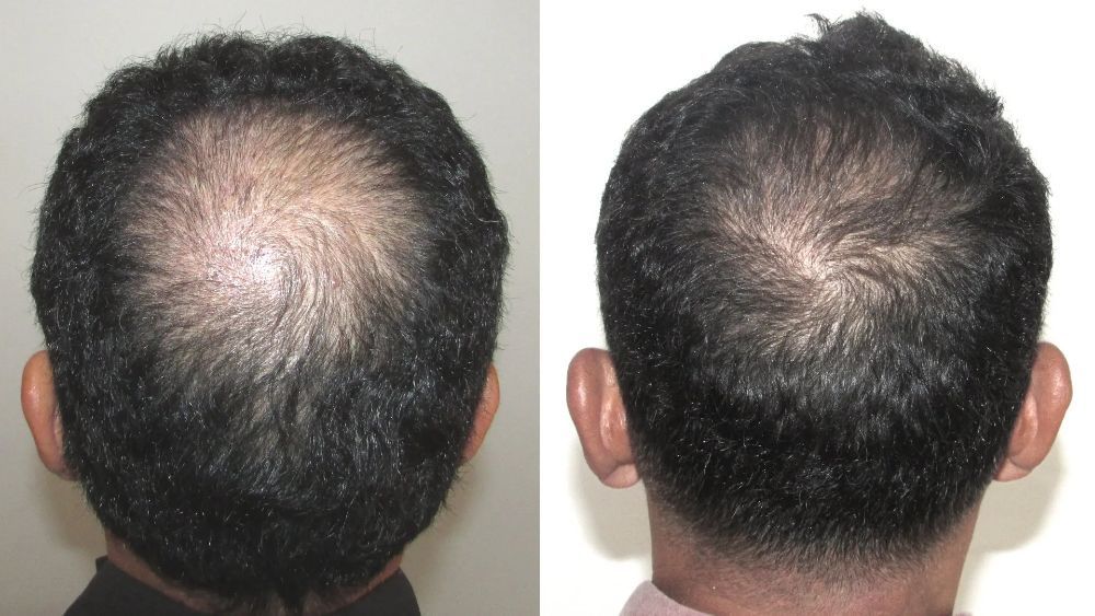 Hair Restoration — Back of Head