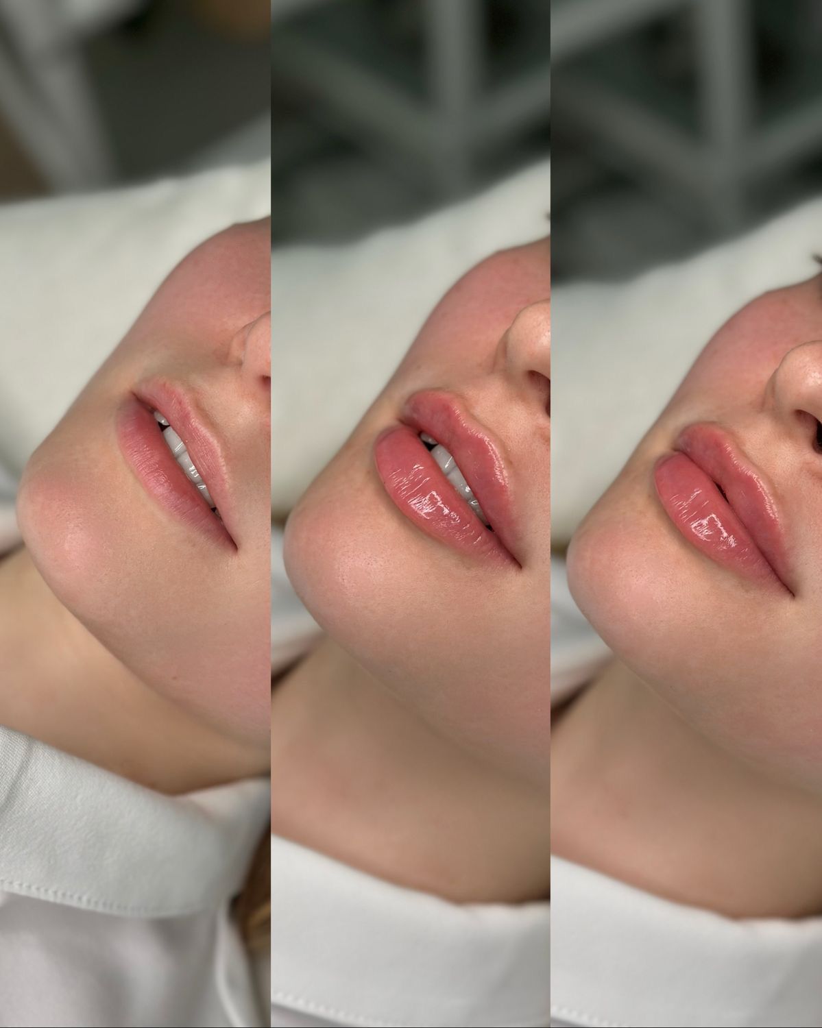 Lip Filler — Natural Volume Enhancement