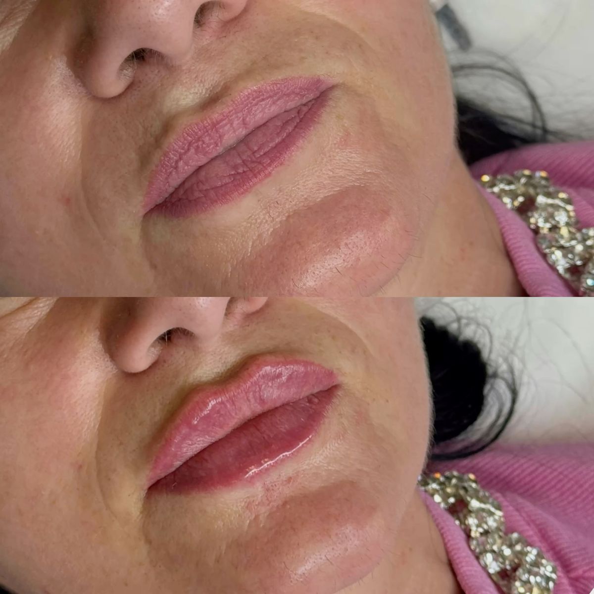 Lip Filler — Volume & Shape