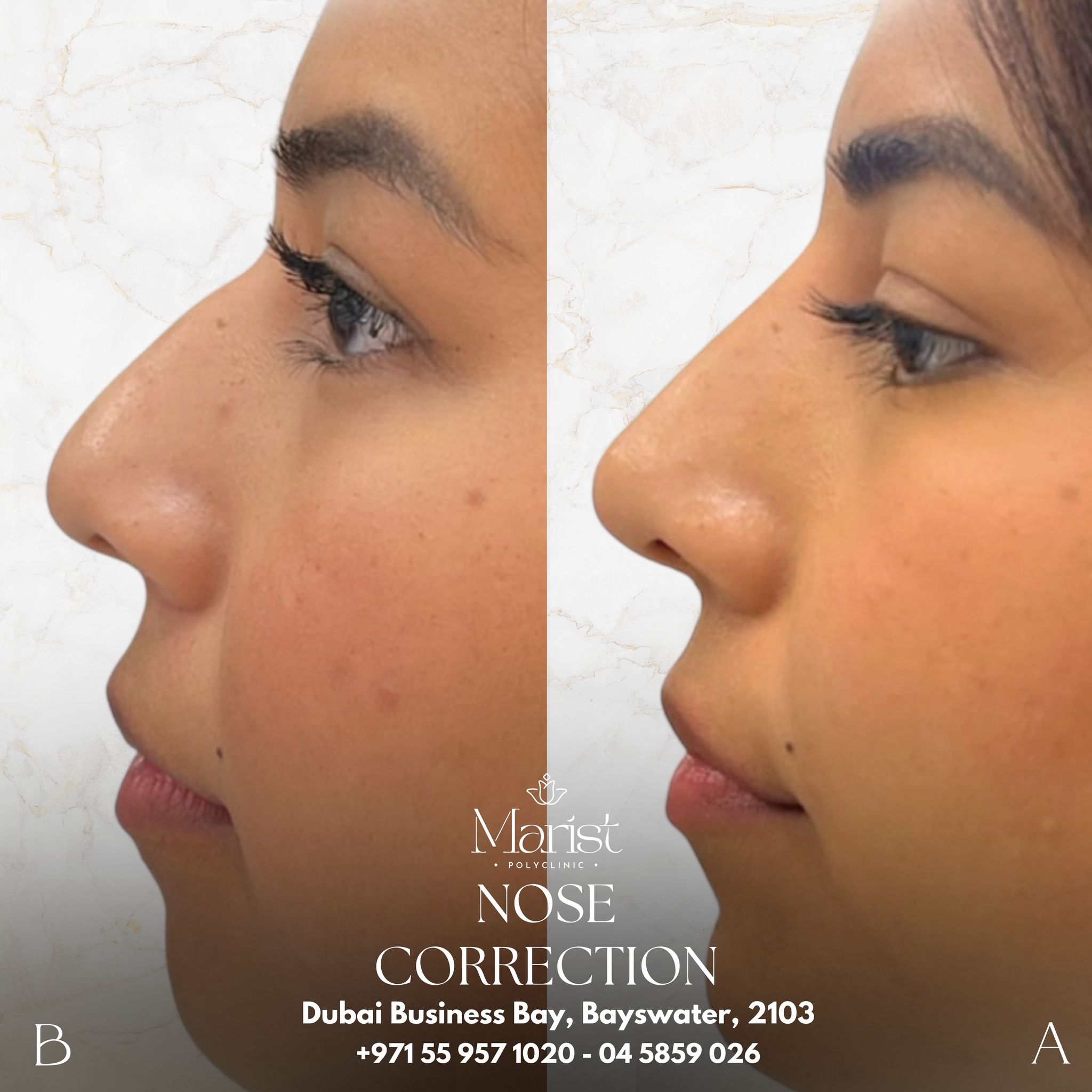 Nose Correction — Non-Surgical Rhinoplasty