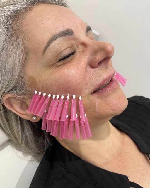 PDO Thread Lift — Face Contouring