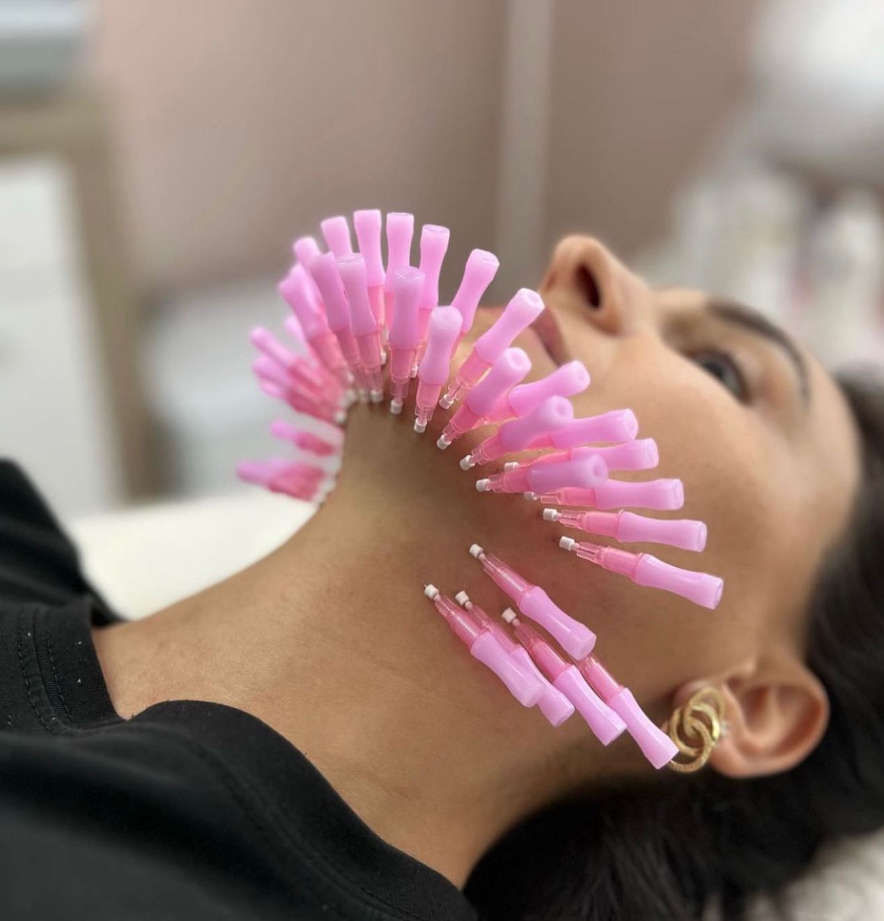 PDO Thread Lift — Jawline Lifting
