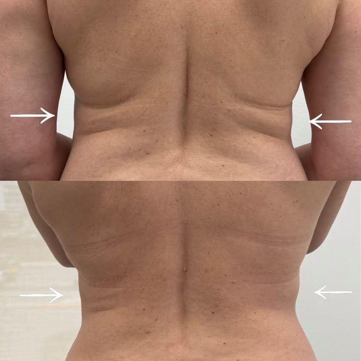 RF Microneedling — Neck Rejuvenation