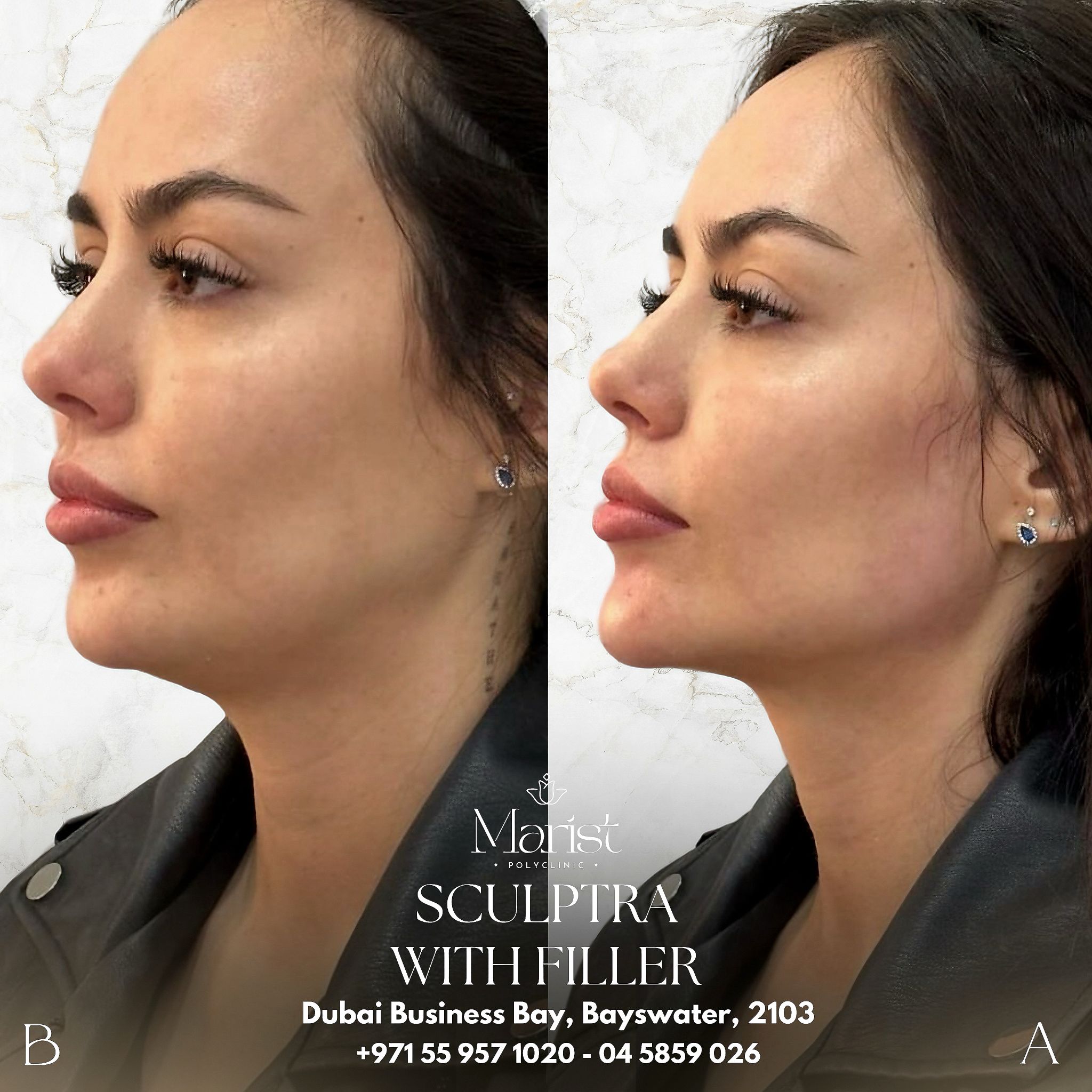 Sculptra & Filler — Full Face Rejuvenation