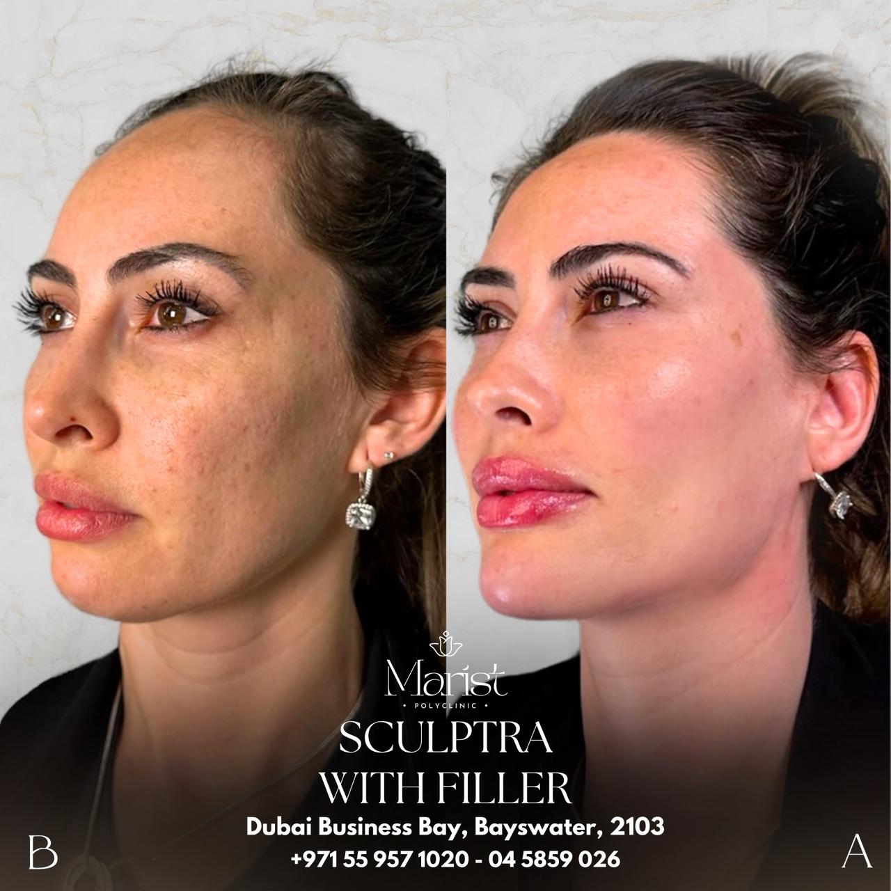 Sculptra with Filler — Face Balancing