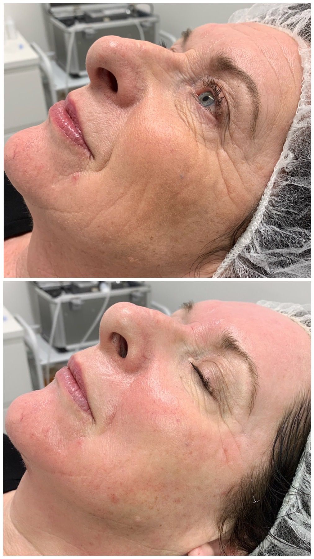 Skin Rejuvenation — Anti-Ageing Results