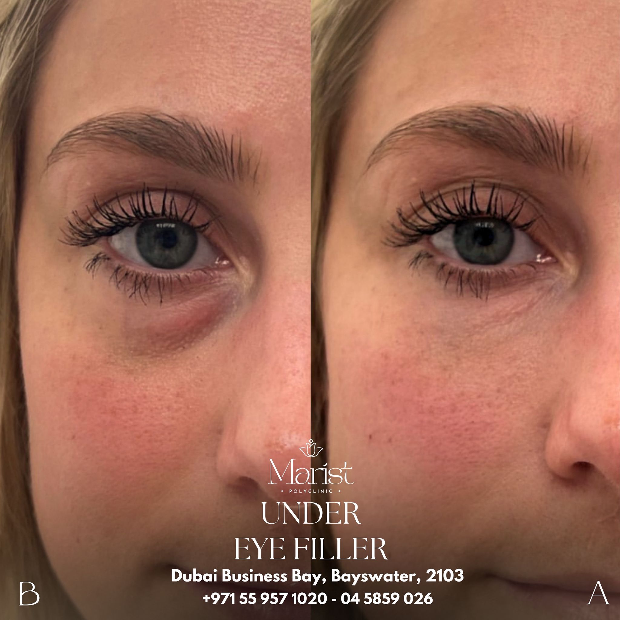 Under-Eye Filler — Dark Circle Correction