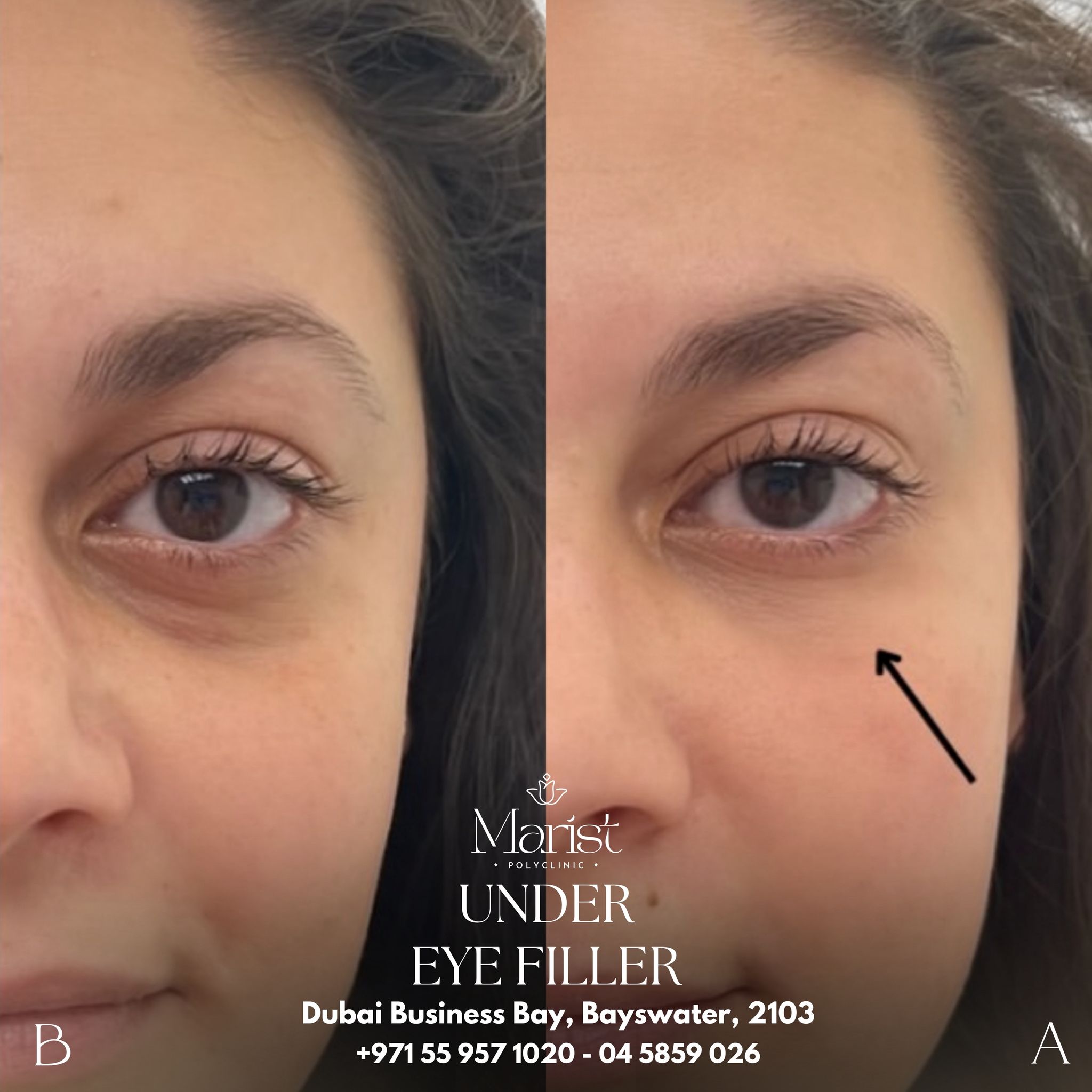 Under-Eye Filler — Hollow Reduction